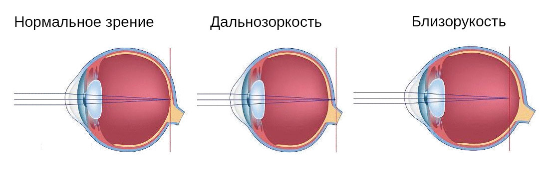 Аккомодация глаза: виды, причины и варианты лечения2