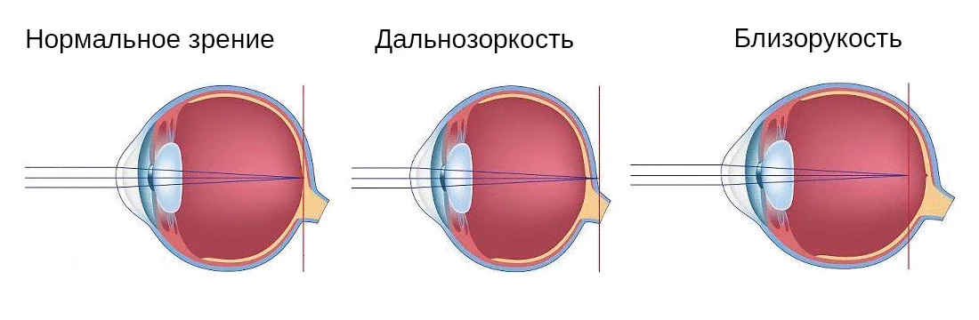 Спазм аккомодации - что это такое? Причины, симптомы и лечение